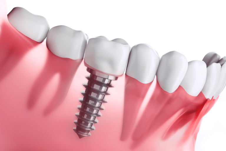 Cicatrisation gencive après implant