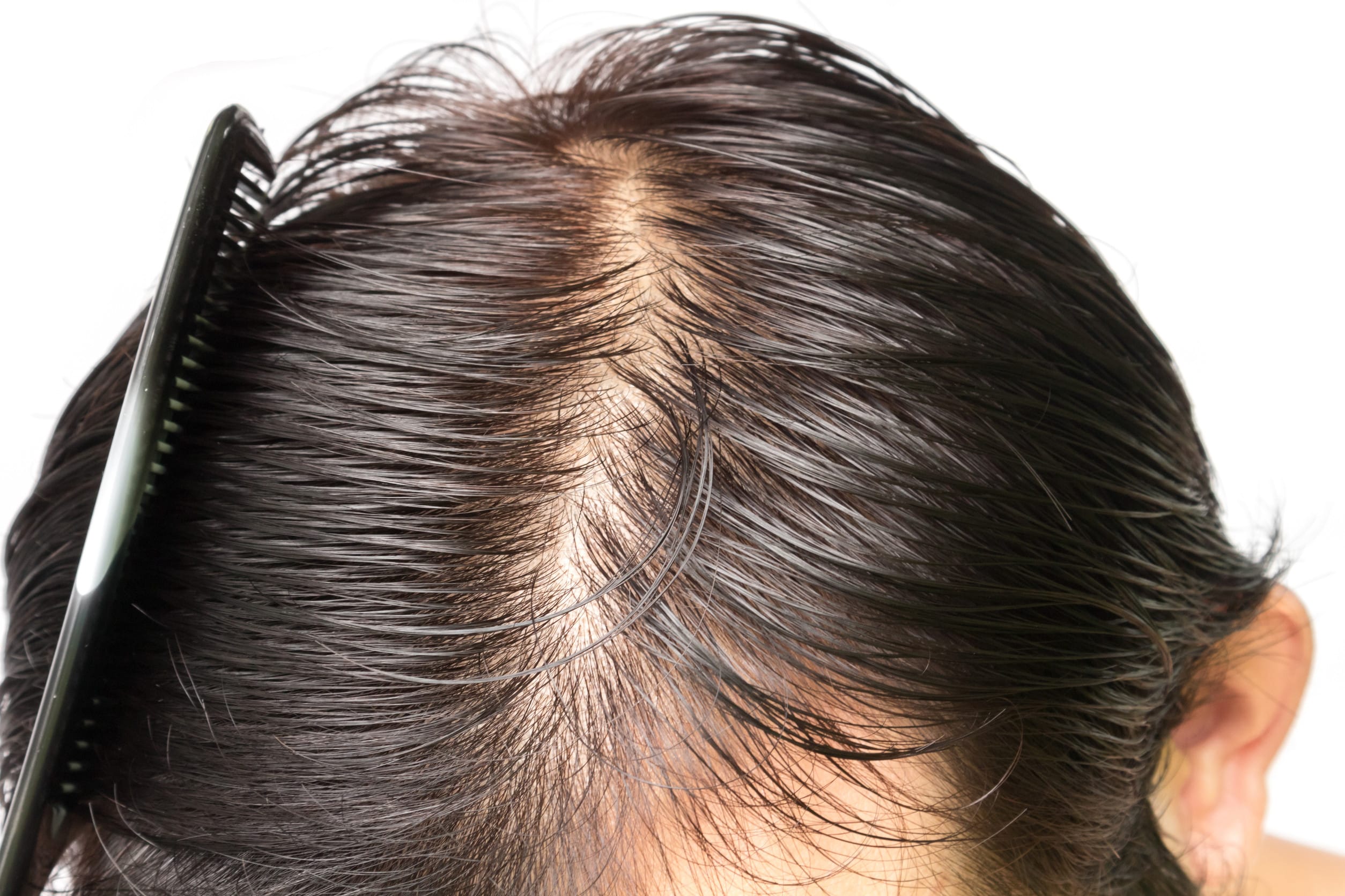 La Greffe Capillaire