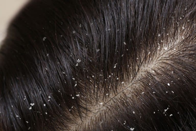 Les meilleures solutions naturelles contre les pellicule