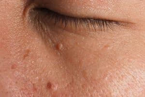 Pourquoi certaines verrues persistent-elles malgré les soins ?